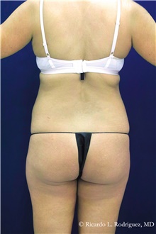 Buttock Implants Before Photo by Ricardo Rodriguez, MD; Lutherville-Timonium, MD - Case 48315