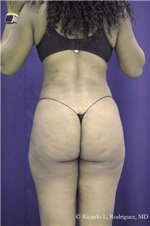 Buttock Implants After Photo by Ricardo Rodriguez, MD; Lutherville-Timonium, MD - Case 48316