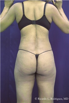 Buttock Implants Before Photo by Ricardo Rodriguez, MD; Lutherville-Timonium, MD - Case 48316