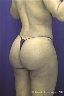 Buttock Implants After Photo by Ricardo Rodriguez, MD; Lutherville-Timonium, MD - Case 48317