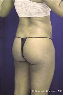 Buttock Implants Before Photo by Ricardo Rodriguez, MD; Lutherville-Timonium, MD - Case 48317