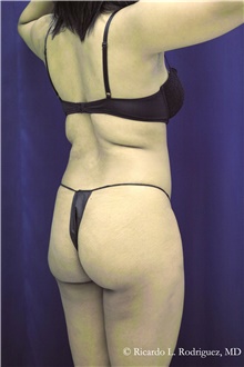 Buttock Implants Before Photo by Ricardo Rodriguez, MD; Lutherville-Timonium, MD - Case 48318