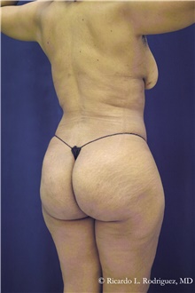 Buttock Implants After Photo by Ricardo Rodriguez, MD; Lutherville-Timonium, MD - Case 48319