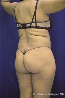 Buttock Implants Before Photo by Ricardo Rodriguez, MD; Lutherville-Timonium, MD - Case 48319