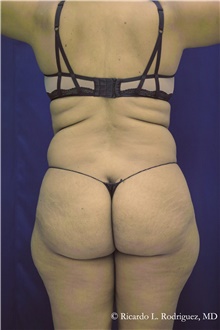 Buttock Implants Before Photo by Ricardo Rodriguez, MD; Lutherville-Timonium, MD - Case 48319