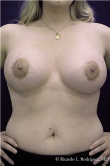 Breast Lift After Photo by Ricardo Rodriguez, MD; Lutherville-Timonium, MD - Case 48320