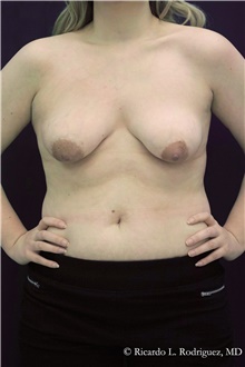 Breast Lift Before Photo by Ricardo Rodriguez, MD; Lutherville-Timonium, MD - Case 48320