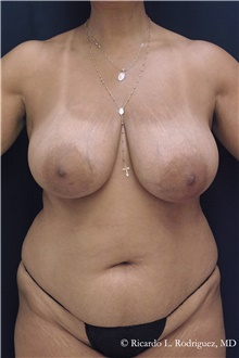 Breast Reduction Before Photo by Ricardo Rodriguez, MD; Lutherville-Timonium, MD - Case 48323