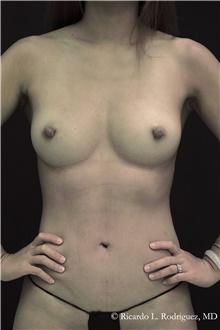 Breast Augmentation After Photo by Ricardo Rodriguez, MD; Lutherville-Timonium, MD - Case 48324