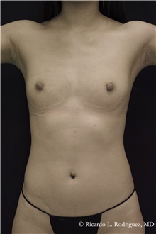 Breast Augmentation Before Photo by Ricardo Rodriguez, MD; Lutherville-Timonium, MD - Case 48324