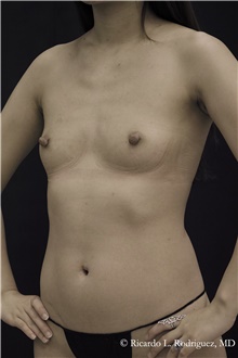 Breast Augmentation Before Photo by Ricardo Rodriguez, MD; Lutherville-Timonium, MD - Case 48324