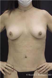 Breast Augmentation After Photo by Ricardo Rodriguez, MD; Lutherville-Timonium, MD - Case 48325