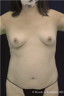 Breast Augmentation Before Photo by Ricardo Rodriguez, MD; Lutherville-Timonium, MD - Case 48325