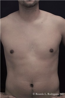Male Breast Reduction After Photo by Ricardo Rodriguez, MD; Lutherville-Timonium, MD - Case 48327