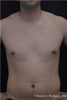 Male Breast Reduction Before Photo by Ricardo Rodriguez, MD; Lutherville-Timonium, MD - Case 48327