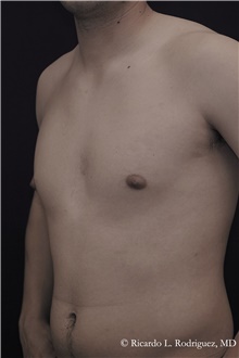 Male Breast Reduction Before Photo by Ricardo Rodriguez, MD; Lutherville-Timonium, MD - Case 48327