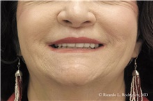 Lip Augmentation/Enhancement After Photo by Ricardo Rodriguez, MD; Lutherville-Timonium, MD - Case 48328