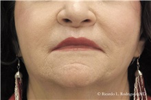 Lip Augmentation/Enhancement After Photo by Ricardo Rodriguez, MD; Lutherville-Timonium, MD - Case 48328
