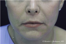 Lip Augmentation/Enhancement After Photo by Ricardo Rodriguez, MD; Lutherville-Timonium, MD - Case 48329
