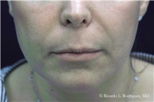 Lip Augmentation/Enhancement Before Photo by Ricardo Rodriguez, MD; Lutherville-Timonium, MD - Case 48329