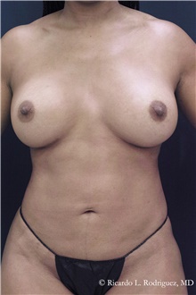 Breast Implant Revision After Photo by Ricardo Rodriguez, MD; Lutherville-Timonium, MD - Case 48330