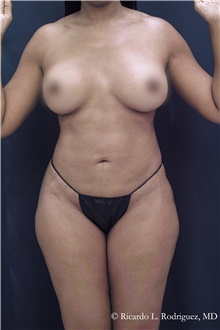 Liposuction After Photo by Ricardo Rodriguez, MD; Lutherville-Timonium, MD - Case 48331