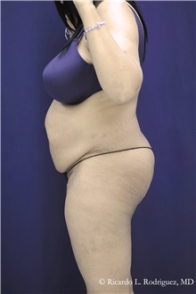 Tummy Tuck Before Photo by Ricardo Rodriguez, MD; Lutherville-Timonium, MD - Case 48333