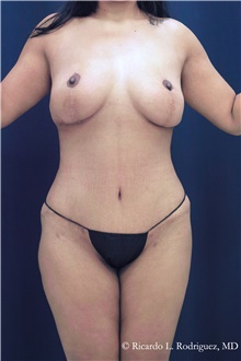 Tummy Tuck After Photo by Ricardo Rodriguez, MD; Lutherville-Timonium, MD - Case 48337