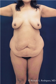Tummy Tuck Before Photo by Ricardo Rodriguez, MD; Lutherville-Timonium, MD - Case 48337
