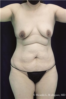 Tummy Tuck Before Photo by Ricardo Rodriguez, MD; Lutherville-Timonium, MD - Case 48338