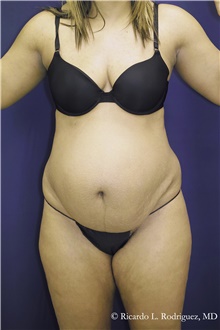Tummy Tuck Before Photo by Ricardo Rodriguez, MD; Lutherville-Timonium, MD - Case 48342