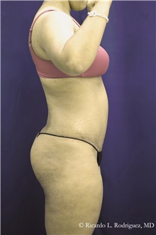 Tummy Tuck After Photo by Ricardo Rodriguez, MD; Lutherville-Timonium, MD - Case 48342