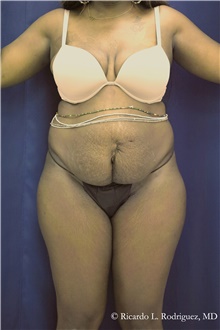 Tummy Tuck Before Photo by Ricardo Rodriguez, MD; Lutherville-Timonium, MD - Case 48343