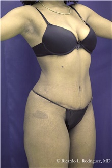 Tummy Tuck After Photo by Ricardo Rodriguez, MD; Lutherville-Timonium, MD - Case 48344