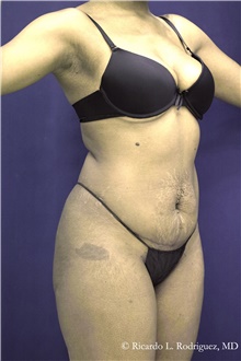 Tummy Tuck Before Photo by Ricardo Rodriguez, MD; Lutherville-Timonium, MD - Case 48344