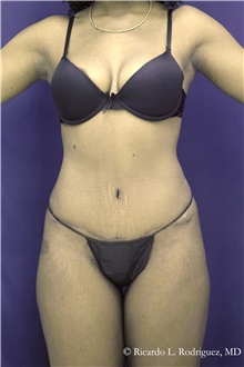 Tummy Tuck After Photo by Ricardo Rodriguez, MD; Lutherville-Timonium, MD - Case 48344
