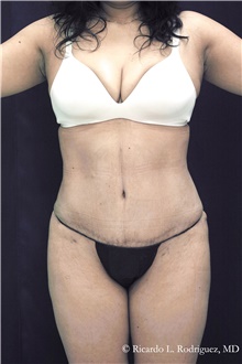 Tummy Tuck After Photo by Ricardo Rodriguez, MD; Lutherville-Timonium, MD - Case 48345
