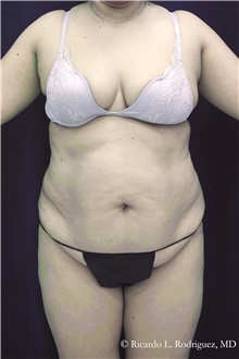 Tummy Tuck Before Photo by Ricardo Rodriguez, MD; Lutherville-Timonium, MD - Case 48345
