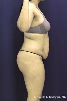 Tummy Tuck Before Photo by Ricardo Rodriguez, MD; Lutherville-Timonium, MD - Case 48346