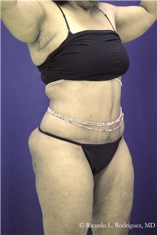 Tummy Tuck After Photo by Ricardo Rodriguez, MD; Lutherville-Timonium, MD - Case 48347