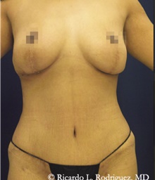 Tummy Tuck After Photo by Ricardo Rodriguez, MD; Lutherville-Timonium, MD - Case 48883