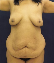 Tummy Tuck Before Photo by Ricardo Rodriguez, MD; Lutherville-Timonium, MD - Case 48883