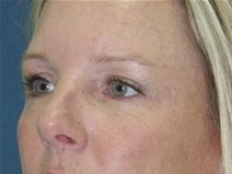 Eyelid Surgery After Photo by Jane Weston, MD; Menlo Park, CA - Case 21217