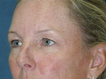 Eyelid Surgery Before Photo by Jane Weston, MD; Menlo Park, CA - Case 21217