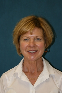 Facelift Before Photo by Jane Weston, MD; Menlo Park, CA - Case 21460