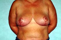 Breast Reduction After Photo by Francis(Frank) Rieger, MD; Tampa, FL - Case 8411