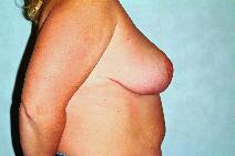 Breast Reduction After Photo by Francis(Frank) Rieger, MD; Tampa, FL - Case 8411