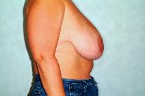 Breast Reduction Before Photo by Francis(Frank) Rieger, MD; Tampa, FL - Case 8411