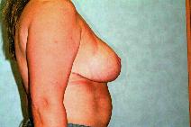 Breast Reduction After Photo by Francis(Frank) Rieger, MD; Tampa, FL - Case 8412