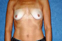 Breast Augmentation Before Photo by Francis(Frank) Rieger, MD; Tampa, FL - Case 8438